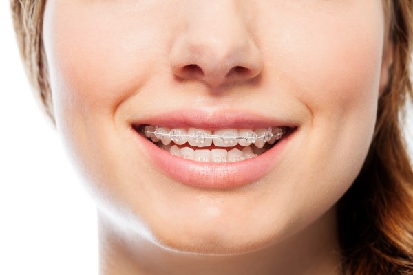 What Are The Benefits Of Choosing Ceramic Braces?