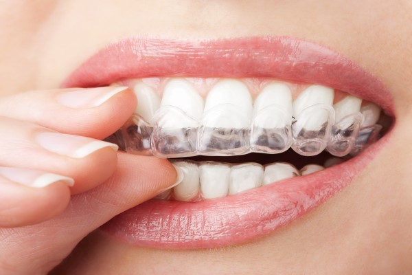 Tips To Help Make Wearing Clear Aligners Easy
