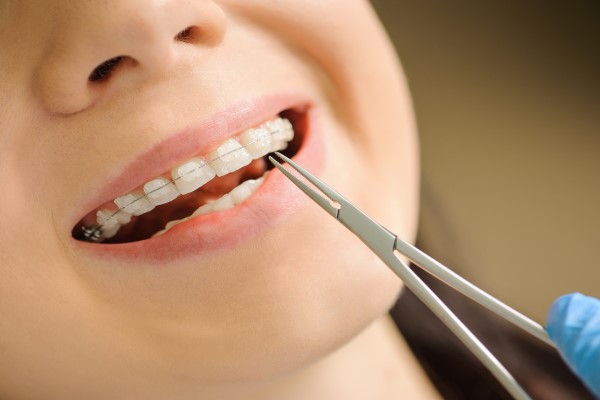 The Benefits Of Clear Braces For Teens