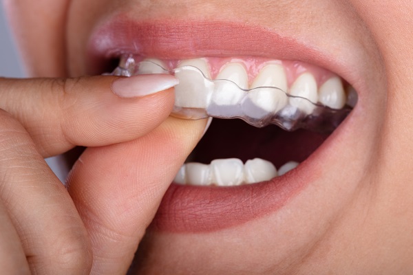 Benefits Of Improving Teeth Alignment With Orthodontics