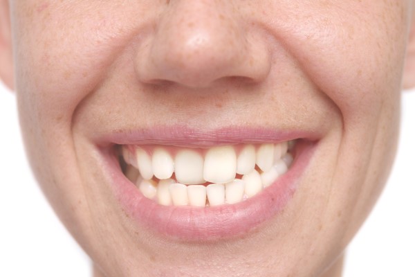 Cosmetic Orthodontics Options For Adults