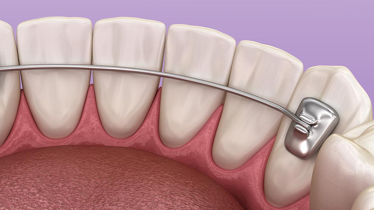 What Do Retainers Look Like