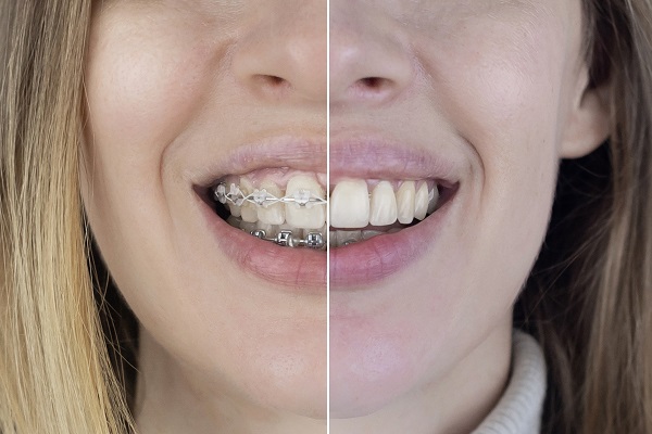 Teeth Straightening Treatments From An Orthodontist